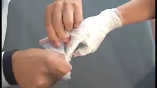 Наложение повязки при повреждении пальцев кисти