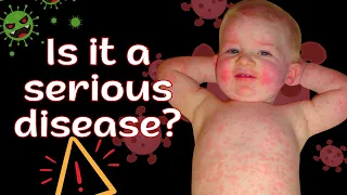 Fifth Disease Rash in Babies (erythema infectiosum): Understanding Symptoms and Treatment