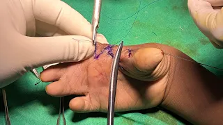 4 Flap Z-plasty for deepening first web space