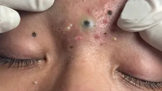 Full Blackhead Popping Video - HOT