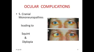 Diabetic Eye Disease