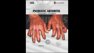 Psoriatic Arthritis