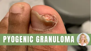 IS THERE A ROCK IN MY TOENAIL?!