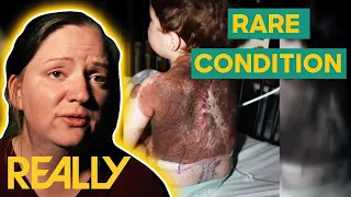 Young Boy With Massive Birthmarks Receives Treatment To Prevent Potential Cancer | Body Bizarre