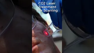 Healing Scars With A Laser! 😯🥽