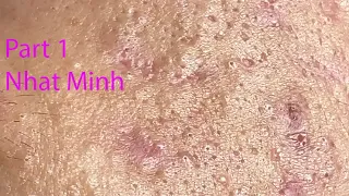 Acne Treatment Huong Da Nang# 029 |  Treatment for Nhat Minh Part 1