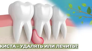 Киста зуба. Удалять  или лечить?☘️