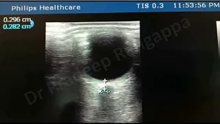 ONSD (Optic Nerve Sheath Diameter)_Dr Pradeep Rangappa