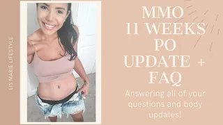 Mommy Makeover Plastic Surgery 11 wpo UPDATE + FAQ!