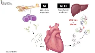 Cardiac Amyloidosis Interpretation Best Practices