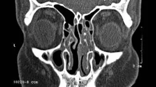 Most Possible CT findings for sinus surgery