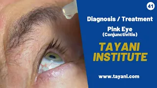Pink Eye (Conjunctivitis) | Tayani Institute