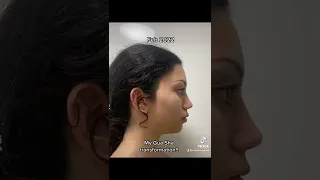 2 month Gua Sha transformation results / tutorial. reliable beauty gurus Bella hadid face lift tut