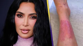 Kim Kardashian Shows Her ‘PAINFUL’ Psoriasis Rash