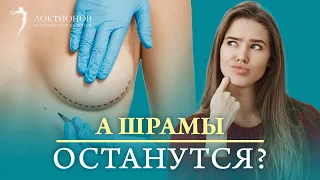 Будут ли заметны рубцы и шрамы после маммопластики? Можно ли их избежать и как их скрыть?