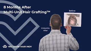 8 Months After Hair Transplant I Brad Holtz