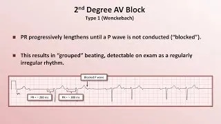 Intro to EKG Interpretation - AV Block