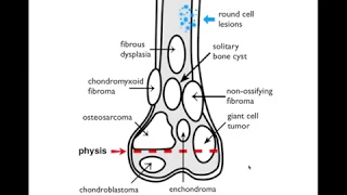 Bone Tumors  - Location Cases - [Basic Radiology]