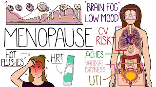Menopause Explained Clearly (Includes HRT & Perimenopause)
