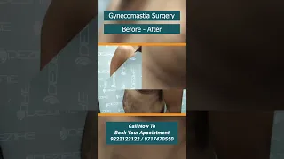 Laser gynecomastia Surgery result before & after #shortvideo