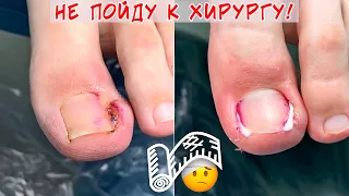 Ingrown nail and pus under the nail / Bitter experience of going to the surgeon