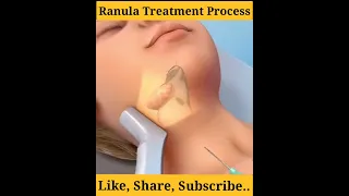 treatment animation 💊🏥 | Ranula Treatment Process #treatment #new