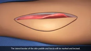 Anterolateral thigh perforator flap harvest
