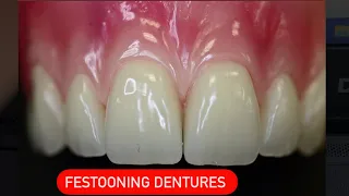 FESTOONING DENTURES/نحت اللثة