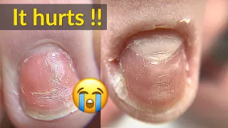 Badly Damaged Nails Transformation with Acrylic