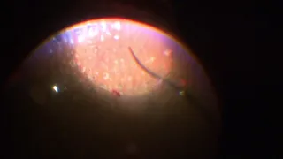 Surgery: Vitreous Hemorrhage in Diabetic Retinopathy: Dr. Manish Nagpal