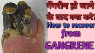 GANGRENE! How to recover? गँगरीन होने के बाद क्या करे?  In Hindi.