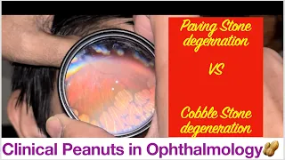 Clinical Peanuts 🥜- Paving stone Vs Cobble Stone // Peripheral Retina Degenration