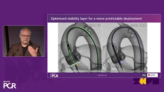 Expanding the heart team - Improved TAVI outcomes through pre-and post-procedure collaboration