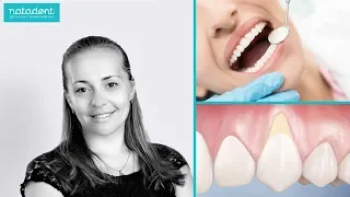 128. Клиновидный дефект зубов. Причины и как лечить? Натадент стоматология