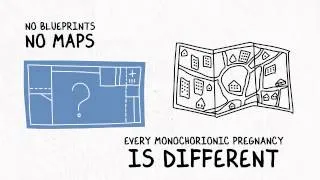 Monochorionic Twins Presentation