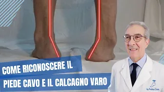 Piede cavo e calcagno varo come riconoscerli. | Dott. Andrea Scala