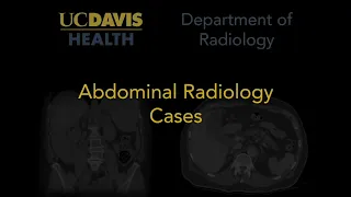 Parathyroid adenoma