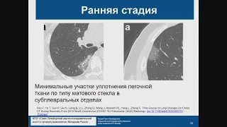 КТ диагностика поражения легких при COVID 19 Лукина О.В.