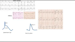 ST elevation on ECG, part 2: case studies