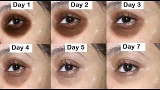 Remove DARK CIRCLES in 7 Days, Under Eye WRINKLES, Eye Bags, Anti Aging Eye mask, Cucumber Eye Gel