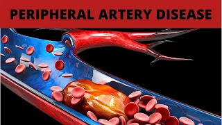 Treatment for Peripheral Artery Disease