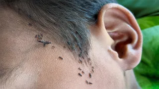 Taking out all thousand lice from his short hair - Remove all hundred lice from black hair