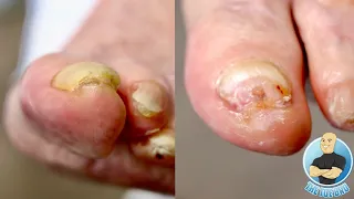 HOW TO MANAGE SUPER THICK & HARD TOENAILS ***IMPORTANT TIPS***