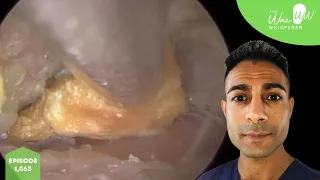 1,063 - Outer Ear Infection Microsuction Compilation