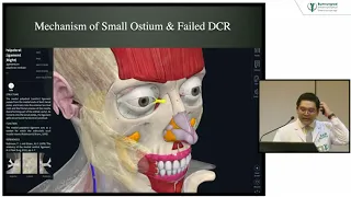 Revision For Endoscopic DCR