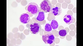 Leucemia Linfoblastica Acuta: le novità terapeutiche e la rivoluzione delle Car-T