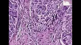 Histopathology Bladder --Urothelial carcinoma Grade I