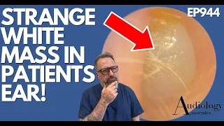 WHAT IS THIS STRANGE WHITE MASS IN PATIENTS EAR? - EP944