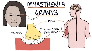 Myasthenia Gravis