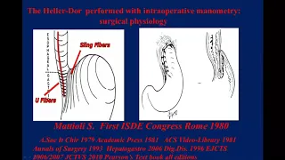 Effects of post myotomy GER in achalasic patients: Data from a 65 year long follow-up program